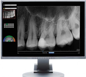Digital X-Rays Willowdaile Family Dentistry