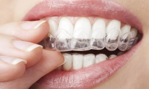 take home teeth whitening